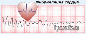Фибрилляция